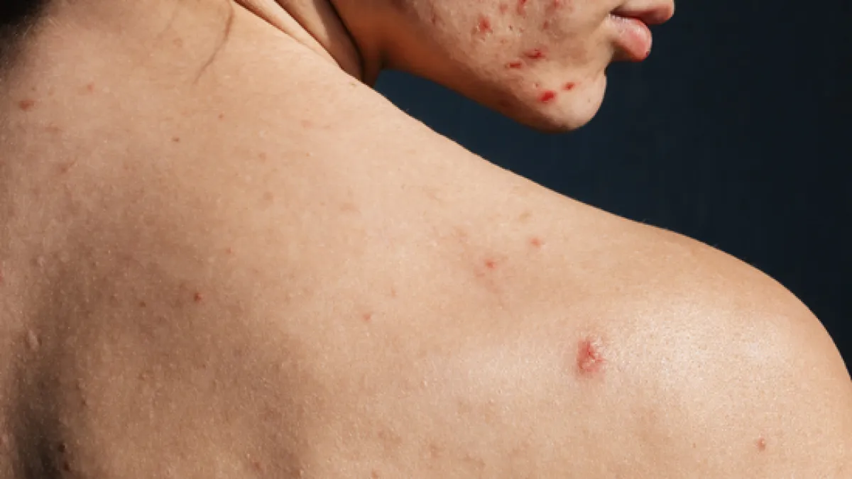 Honey for Scars from Acne: Natural Healing Tips That Work