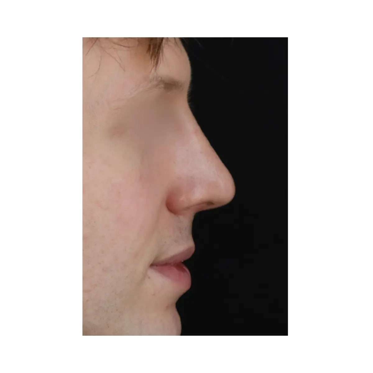 Male Rhinoplasty London