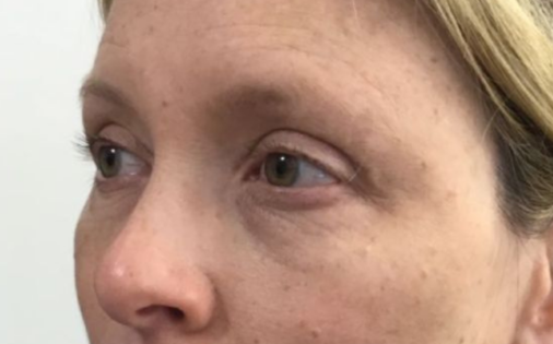 Unknown After Upper Blepharoplasty Three Quarters