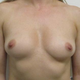 Breast Augmentation with Implants Before 4