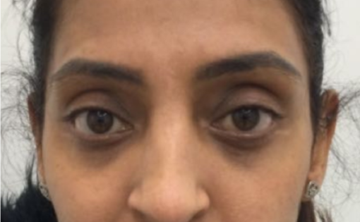 EH After Lower Blepharoplasty