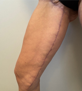 SSJ Thigh Lift After