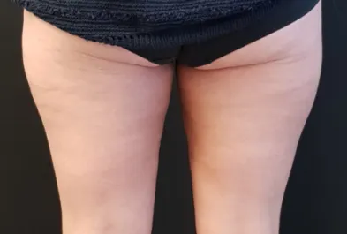 HS Inner Thigh Liposuction After 1 Back