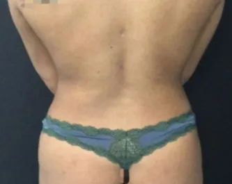 HS Flanks Liposuction After 1 Back