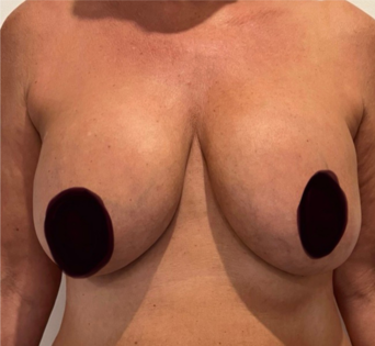 GG Before Mastopexy Front
