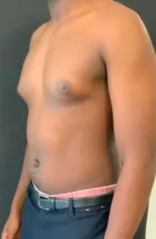 OT Male Chest Lipo Before 1 Three Quarter