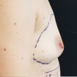 Cadogan Clinic HS FT Breast Before