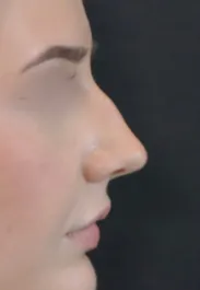 TJ Rhinoplasty Before Side
