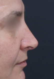 TJ After Septorhinoplasty