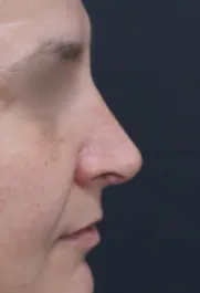 TJ After Septorhinoplasty