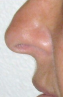TT Before Nose Tip Rhinoplasty