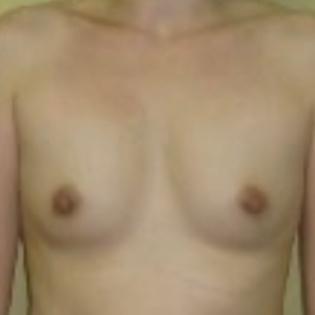 Fat Transfer Breast Before 4