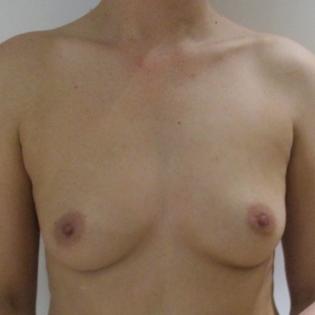 Breast Augmentation with Implants Before 2