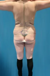 OT Flanks Liposuction Before 1 Back