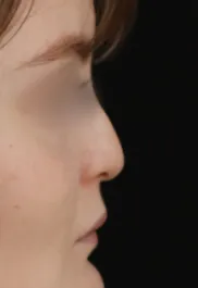 TJ Before Septorhinoplasty Profile