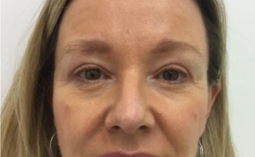 Unknown After Upper Blepharoplasty