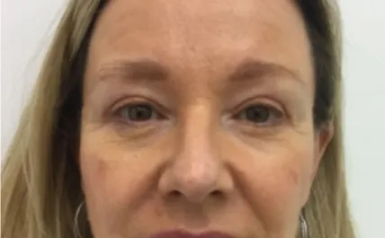 Unknown After Upper Blepharoplasty