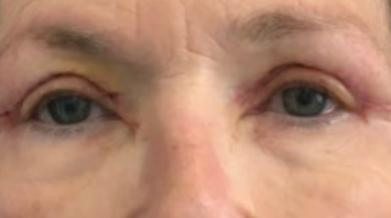 EH After Upper Blepharoplasty