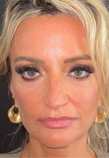 SP Before Septorhinoplasty Front