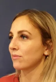 Unknown After Rhinoplasty