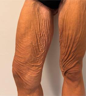 SSJ Thigh Lift Before