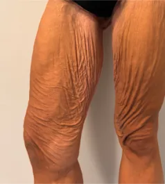 SSJ Thigh Lift Before