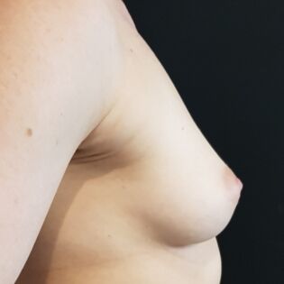 Cadogan Clinic HS FT Breast Before