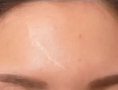 does melanotan permanently darken skin Changes in Oral Mucosa Associated with Melanotan II Injections: A Case  Report main image 0