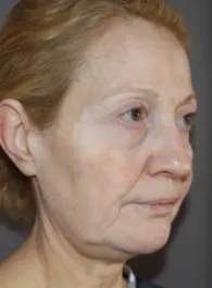 TT Before Face and Neck Lift, Bleph and Fat Transfer