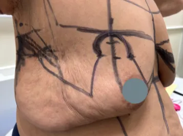 SSJ Mastopexy Before