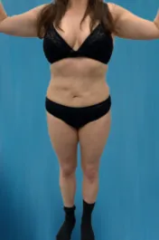 OT Abdomen Lipo After 1 Front