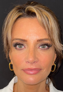 SP After Septorhinoplasty Front