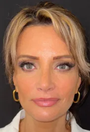 SP After Septorhinoplasty Front