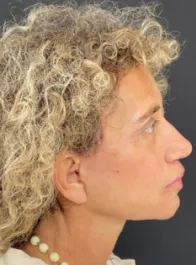 KY After Deep Plane Face and Neck Lift, Brow Lift