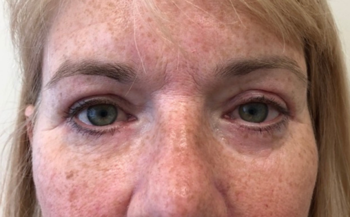 GG After Upper and Lower Blepharoplasty