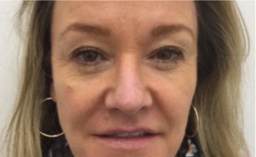 Unknown Before Upper Blepharoplasty