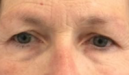 EH Before Upper Blepharoplasty