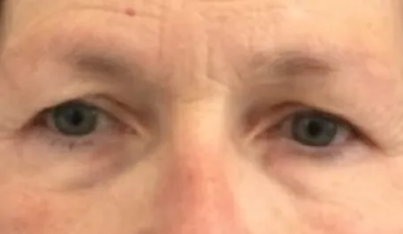 EH Before Upper Blepharoplasty