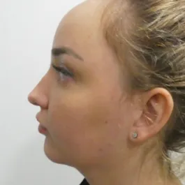 Unknown After Rhinoplasty