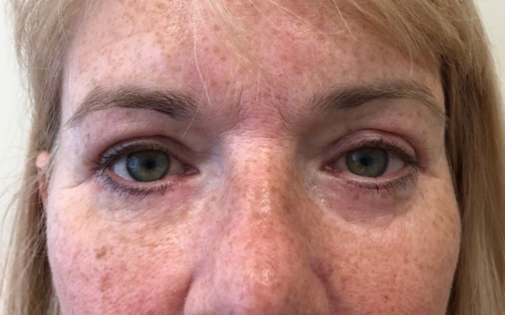 GG After Upper and Lower Blepharoplasty