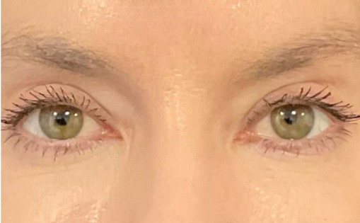 KY After Upper Blepharoplasty Front