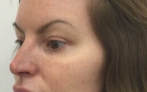 EH After Upper Blepharoplasty