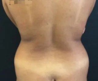 HS Flanks Liposuction Before 1 Back