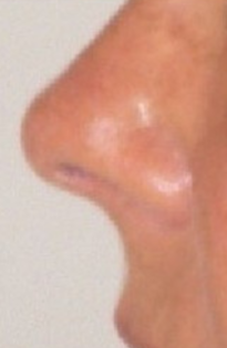 TT After Nose Tip Rhinoplasty