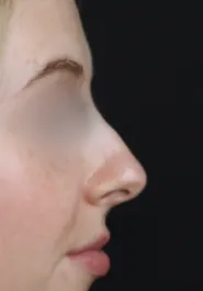 TJ Rhinoplasty Before Side