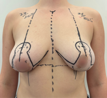 WVN Before Mastopexy