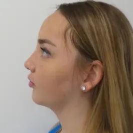 Unknown Before Rhinoplasty