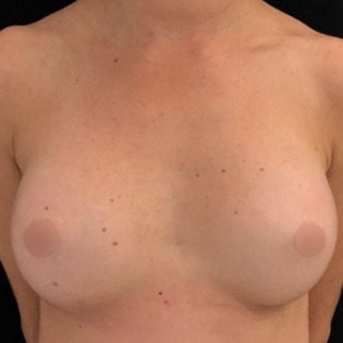 Cadogan Clinic LDL Breast Augmentation After