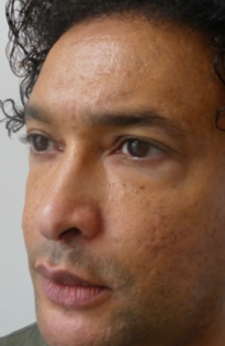 PT Before Nose Tip Rhinoplasty