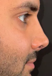 SP After Septorhinoplasty Profile